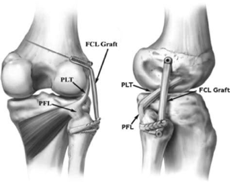 Posterior-anterior and lateral views of an isolated anatomic fibular... | Download Scientific ...