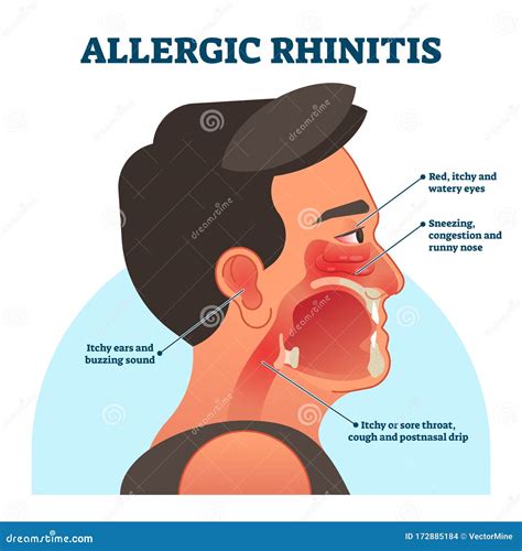 Allergic Rhinitis Medical Diagram, Vector Illustration Labeled Information Stock Vector ...