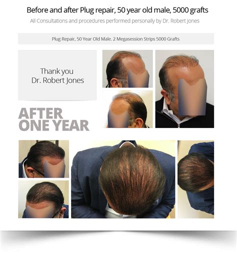 Hair Transplant Results - Toronto Hair Transplant Surgeons