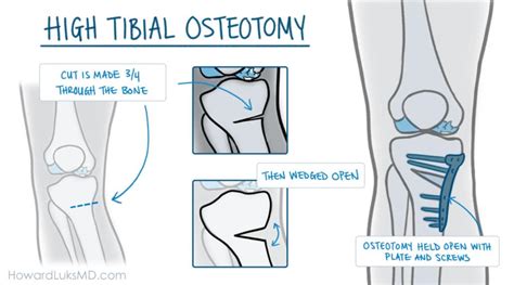 High Tibial Osteotomy For Knee Arthritis Pain In Active People