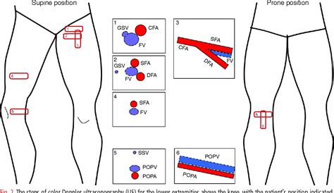 Lower Extremity Arterial Doppler Velocities