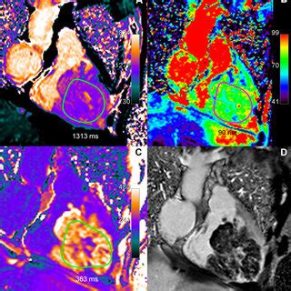 Renal cell carcinoma metastasis: Huge right ventricular metastasis of a... | Download Scientific ...