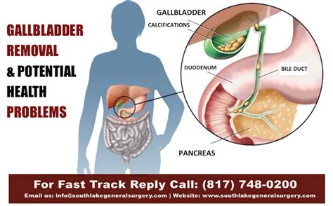 Gallbladder cancer treatment,Gallbladder surgeon Texas Dr.Valeria Simone