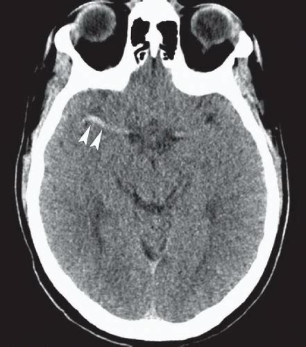 Dense Mca Sign