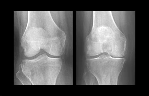 USDA ARS Online Magazine Low Vitamin D Linked to Osteoarthritis