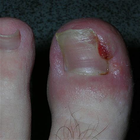 Ingrown Toenail Surgery & Removal Kent | The Foot Clinic