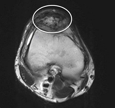 Compva: Imaging — Arteriovenous malformation