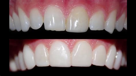 Dental Procedures of Placing Dental Veneers at Cosmetic Dental ...