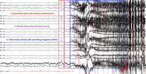 Generalized Seizure Eeg