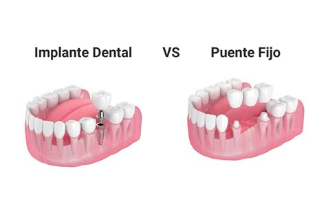 Implantes Dentales VS Puente Fijo - Sonrisa Para Todos