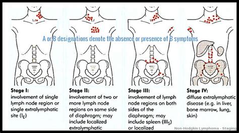 Non-Hodgkin-Lymphom #hodgkin #lymphom | Gesundheitsprodukte, Pathologie ...