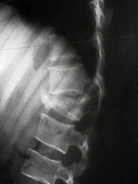 What Is A Burst Fracture