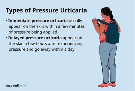 Pressure Urticaria: Symptoms, Causes, and Treatment