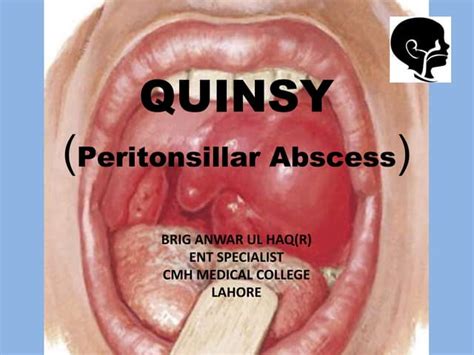 quinsy-2.pdf | Free Download