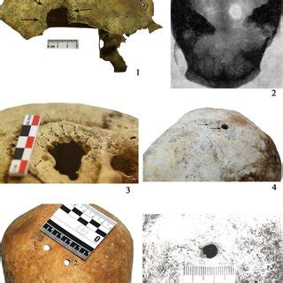 Skulls with traces of trepanation: | Download Scientific Diagram