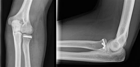 Radial Head Fracture | Orthopaedic Trauma Association (OTA)