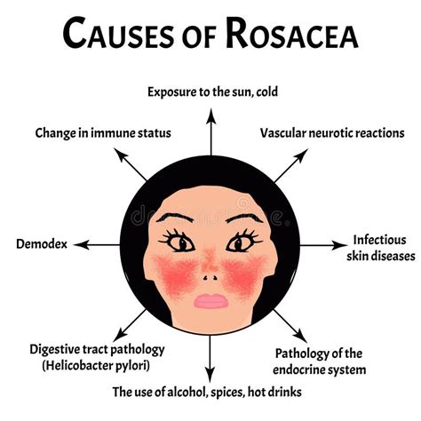 Causas Da Rosácea. Mês De Sensibilização Para a Rosácea. Infográfico. Ilustração Vetorial Em ...