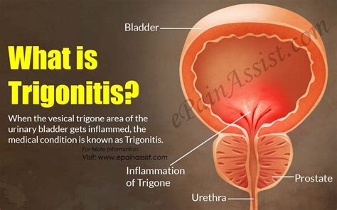 What is Trigonitis | Salud