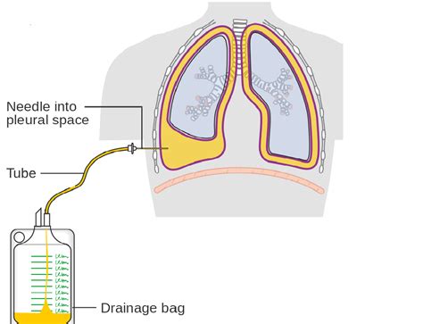 Lung Drainage - Best Drain Photos Primagem.Org