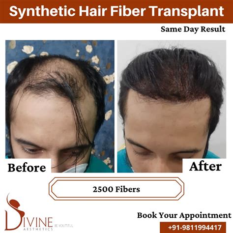 Bio Synthetic Hair Transplant Price In Delhi (India) - Cost of ...