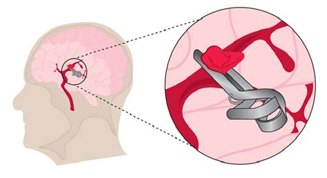 Aneurysm Clips - LithosMed