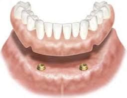 Snap On Overdentures | Rainbow Valley Dental