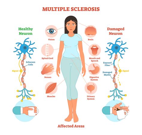 Esclerosis múltiple, una enfermedad del sistema nervioso