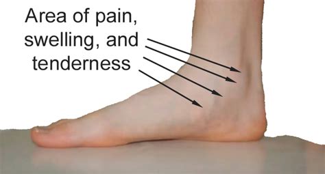 Posterior Tibial Tendon Insertion