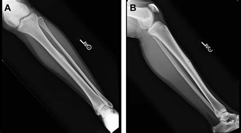 Tibial Stress Fractures in Athletes - Orthopedic Clinics