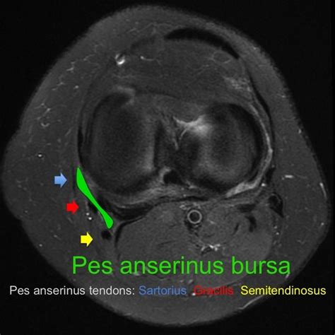 Annotated MR imag... | Pes anserinus, Radiology, Bursa