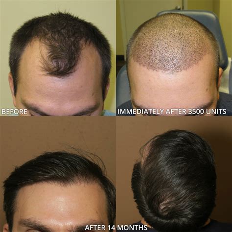 FUE Hair Transplantation – Before and After Pictures * | Dr Turowski - Plastic Surgery Chicago