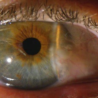 (PDF) Measurement and Topography Guided Treatment of Irregular Astigmatism