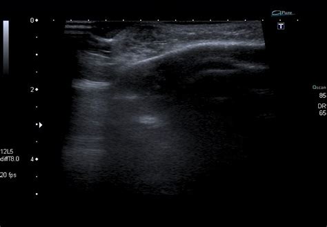 Hemangioma ultrasound - wikidoc