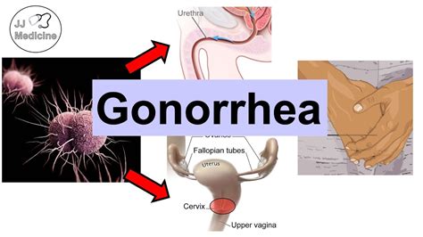 Gonorrhea (Neisseria Gonorrhea) | Pathophysiology, Symptoms ...