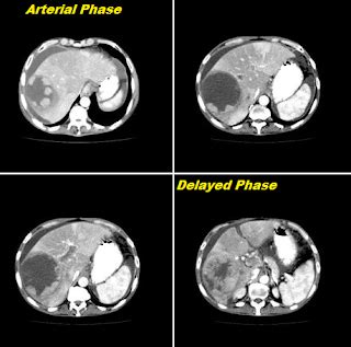 Hepatic Hemangioma- CT - Radiology Imaging