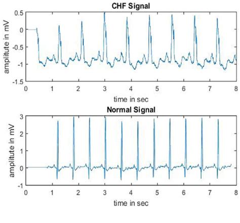 Figure 4 from Morphological changes in congestive heart failure ECG | Semantic Scholar