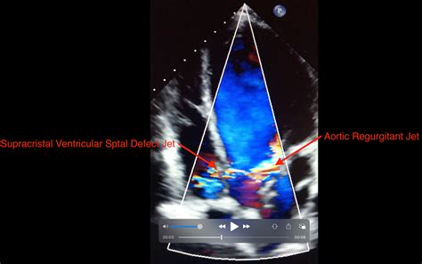 Cureus | Case of Supracristal Ventricular Septal Defect and Aortic ...