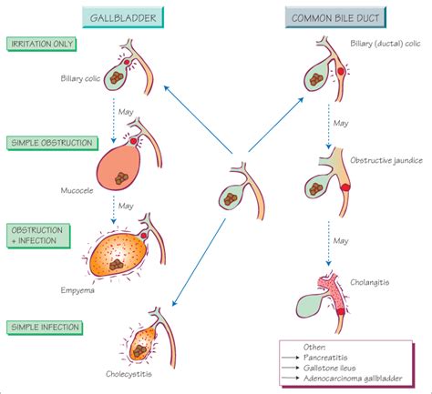 Cholangitis Vs Cholecystitis