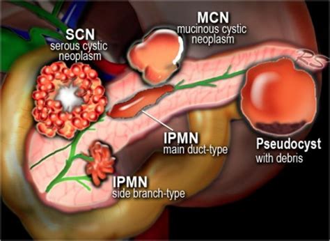 Pancreas Cysts Treatments North Dallas & Plano TX - Kedia