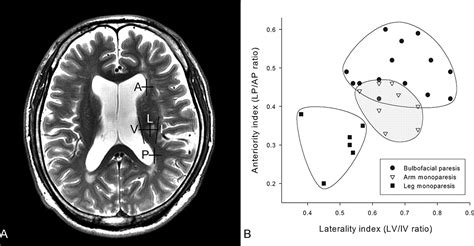 Somatotopic Organization of Motor Fibers in the Corona Radiata in Monoparetic Patients With ...