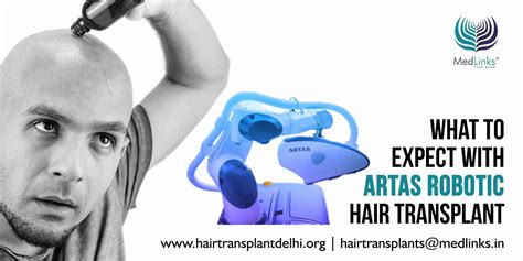 Artas Robotic Hair Transplant In Delhi Ncr | Medlink