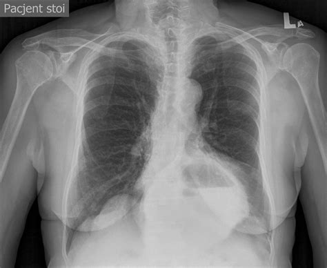 Paraesophageal Hernia X Ray