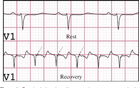 Figure 1 from Epsilon wave uncovered by exercise test in a patient with ...