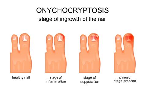 Ingrown Toenail Pain | Hablamos Espanol | Corona