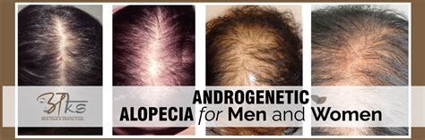 Androgenetic Alopecia For Men and Women | Hair Treatment Clinic