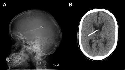 Figure 1 from Radiological evaluation of ventriculoperitoneal shunt ...