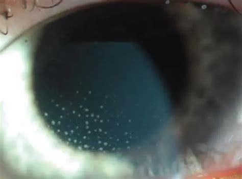 Anterior Uveitis Flare Cells