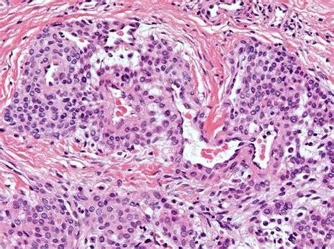 Glomus Tumor - Pathology - Orthobullets