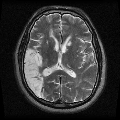 ENG case -- parietal lobe stroke