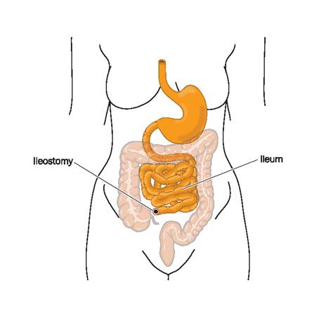 Ileostomy Information l United Ostomy Associations of America